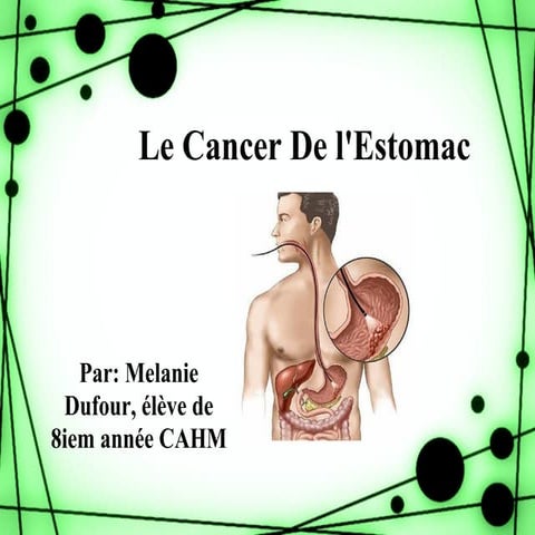 Le cancer de_l_estomac