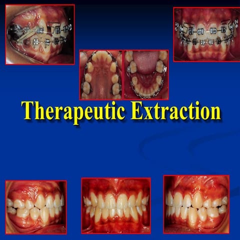 Therapeutic Extraction