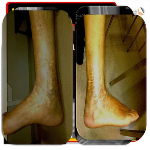 Lecture 29 shah diabetic fractures   copy