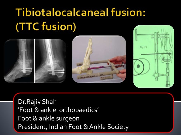 Lecture 37 shah ttc fusion