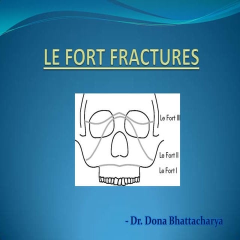 Le fort fracture(2) | PPTX