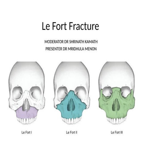 Le fort fractures | PPT