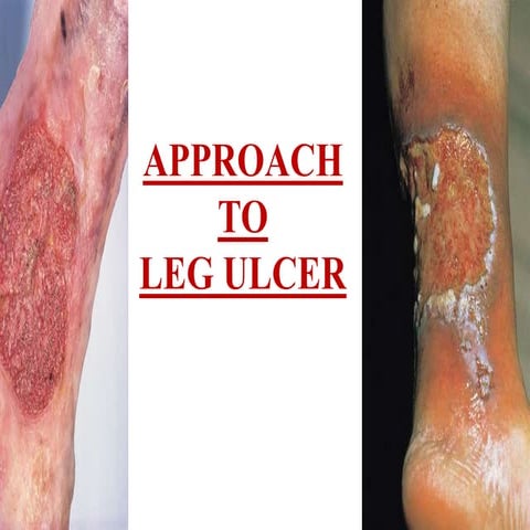 Leg ulcer