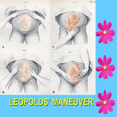 Leopolds’ maneuver