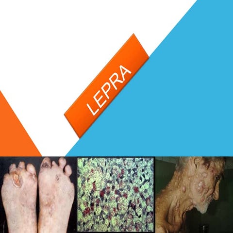 Lepra