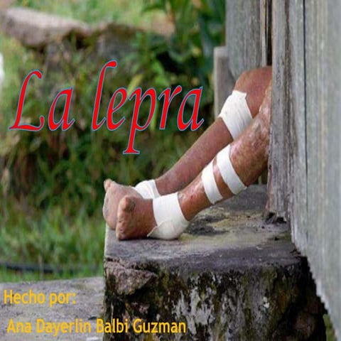 Lepra  