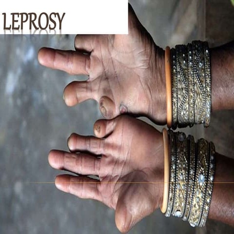 Leprosy