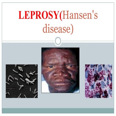 Leprosy