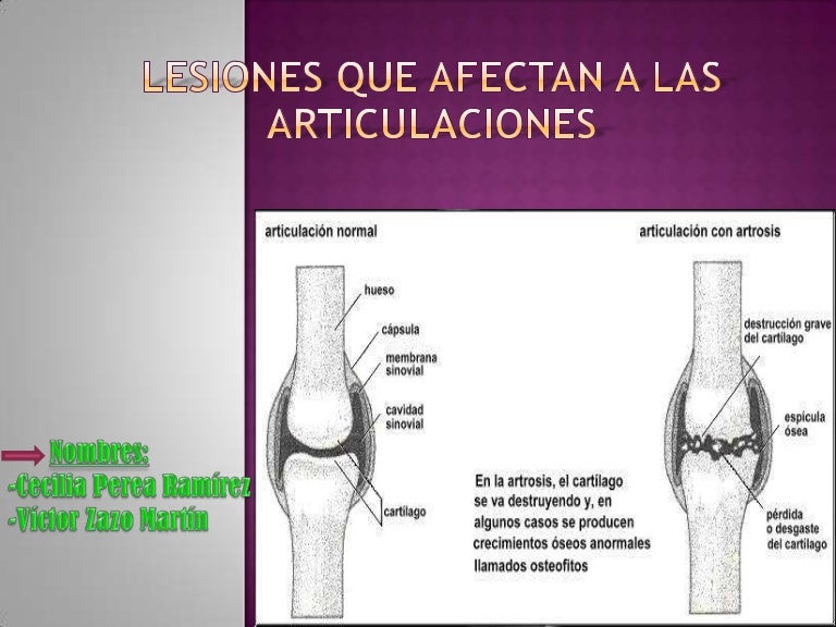 Lesiones que afectan a las articulaciones