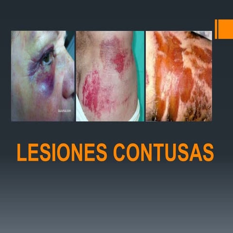 Lesiones contusas