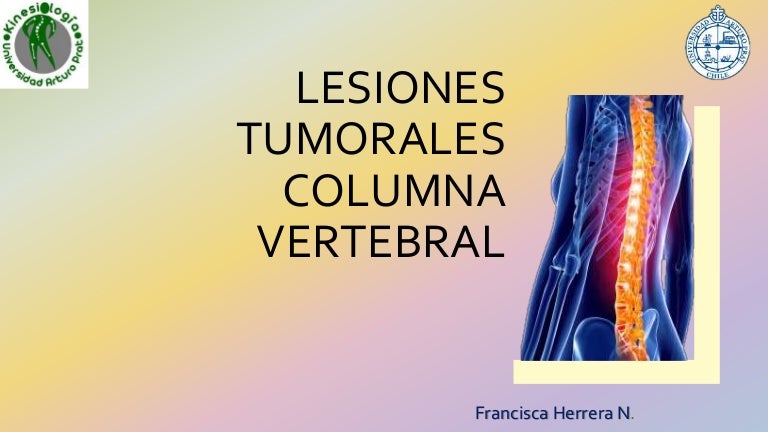 metástasis óseas por localización de vértebras de cáncer de próstata