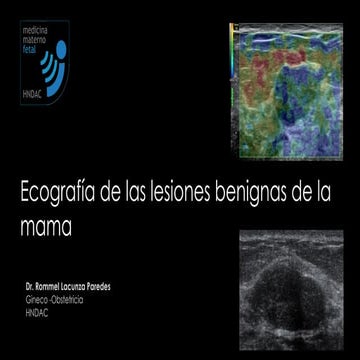 Ecografia: Lesiones benignas de la mama 