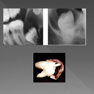 Quistes de Origen Odontogenico y Tu...