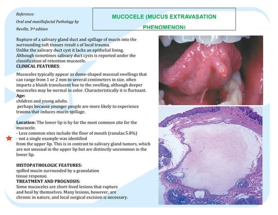 Pulp polyp ...Dr.Anubhuti | PPT