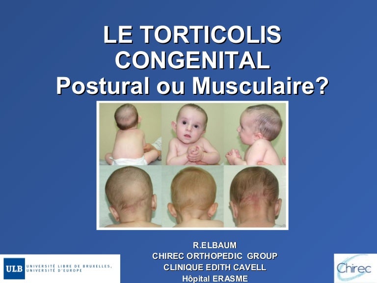 Le Torticoli Congenital Musculaire Ou Postural
