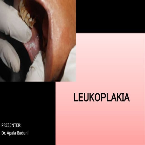 Leukoplakia