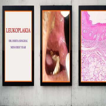 Leukoplakia case presentation
