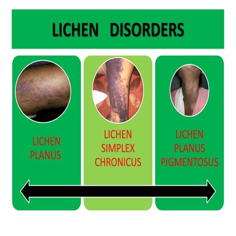 Ayurvedic Treatment  for Lichen Planus , PLEVA , Lichen Simplex , LPP , PLC  ...