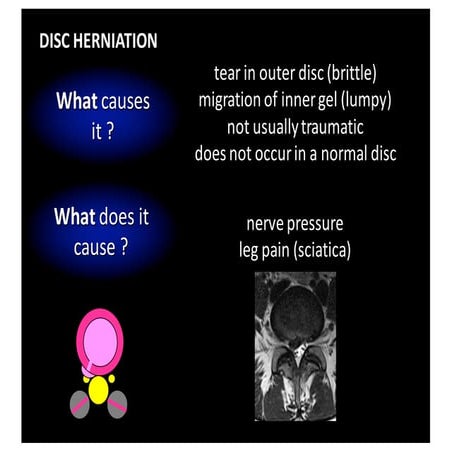 Licina lumbar disc herniation