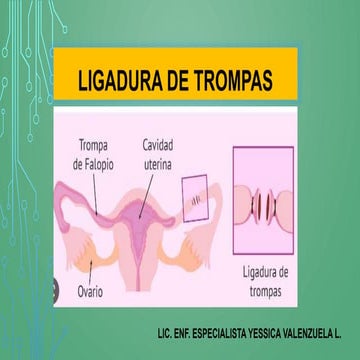 lig de trompas.pptx