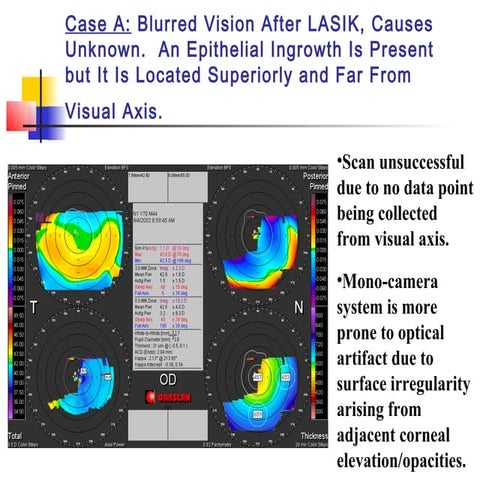 Limitations of Corneal topography