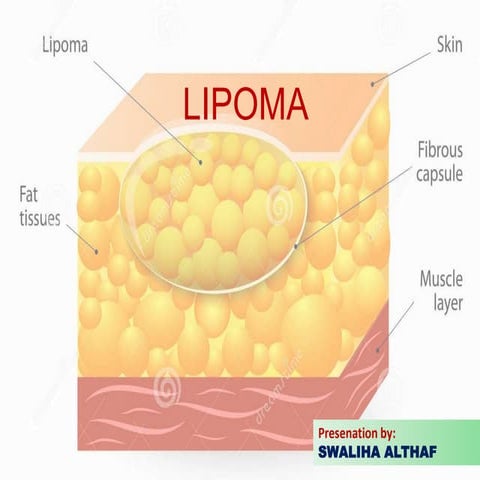 Lipoma 