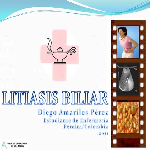 Litiasis biliar