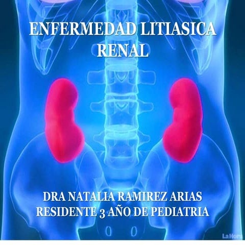 Litiasis renal en pediatria