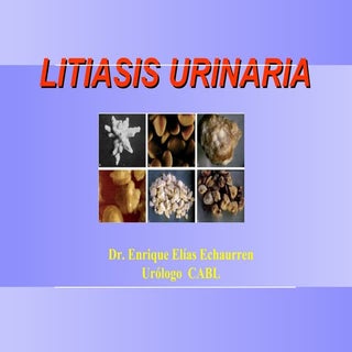 Litiasis renal 