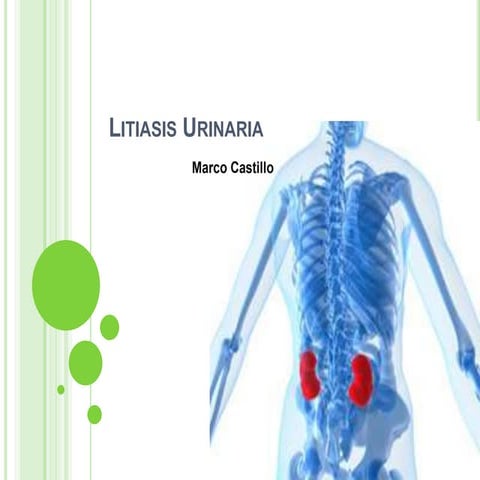 Litiasis urinaria
