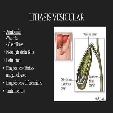 LITIASIS_VESICULAR.pptxtrtratamiento2025 | PPTX