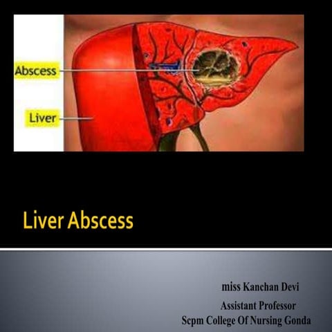 Liver abscess | PPTX