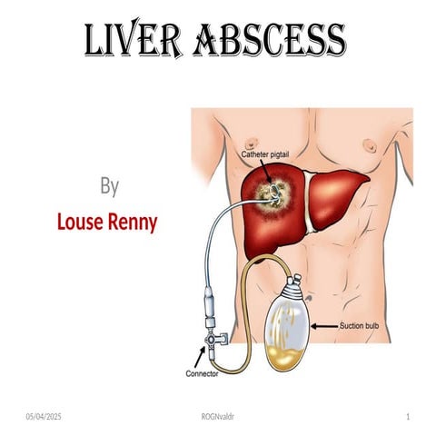 Liver Abscess in the body of a human being.pptx