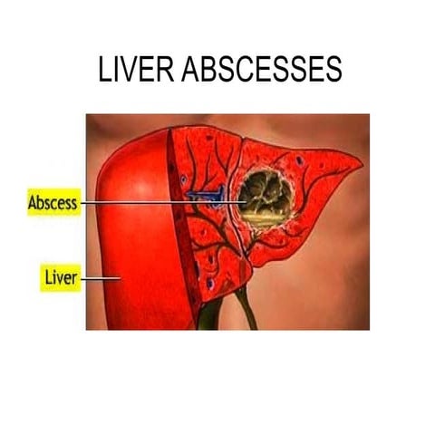 LIVER ABSCESS FINAL.ppt. etiology , pathogenesis, treatment | PPT