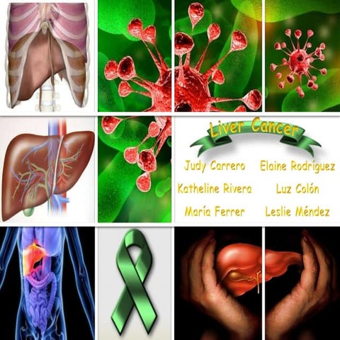 Liver cancer 