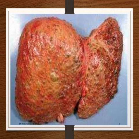 Liver cirrhosis, Clinical Presentation, Complications and Treatment.