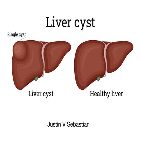 Liver Cyst.pdf