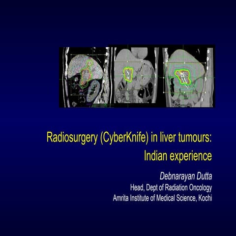Radiosurgery (CyberKnife) in Liver Tumours: Indian Experience
