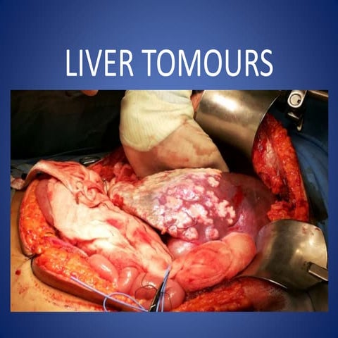 Liver tomour