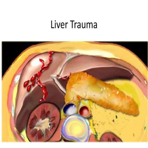 Liver trauma: A comprehensive review of classification, mechanisms, early man...