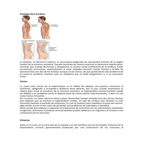 Lordosis