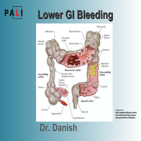 Lower-GI-Bleeding 3 April Dr. Danish.ppt