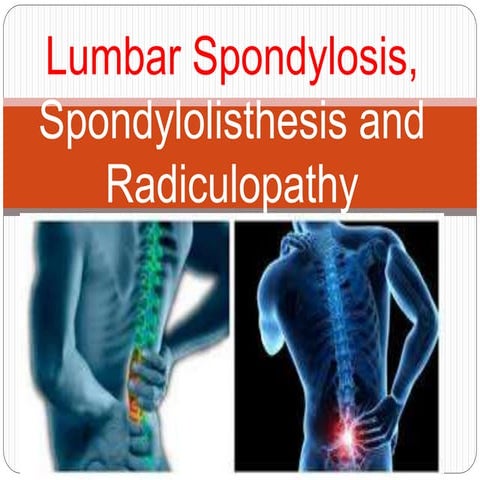 Lumbar Spondylosis, Spondylolisthesis and Radiculopathy