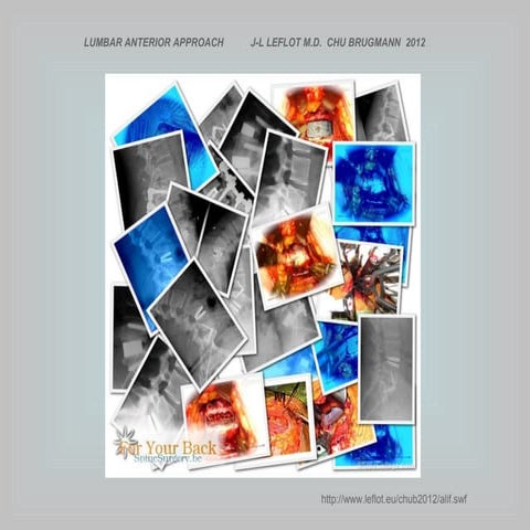 Lumbar anterior approach   leflot