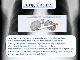 'lung cancer' on SlideShare