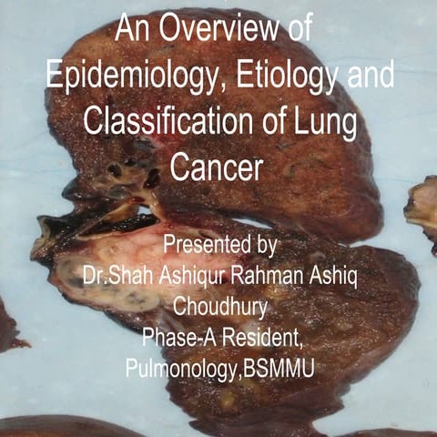 Lung cancer; epidemiology,etiology and classification