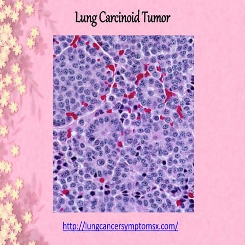 Lung carcinoid tumor