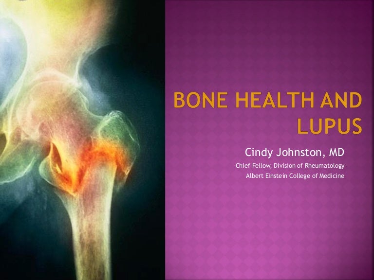 Lupus.and.bonehealth