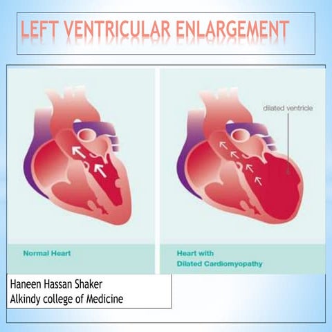 Left ventricular enlargement radiology
