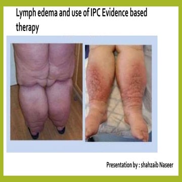 lymph edema and use of ipc evidence.pptx